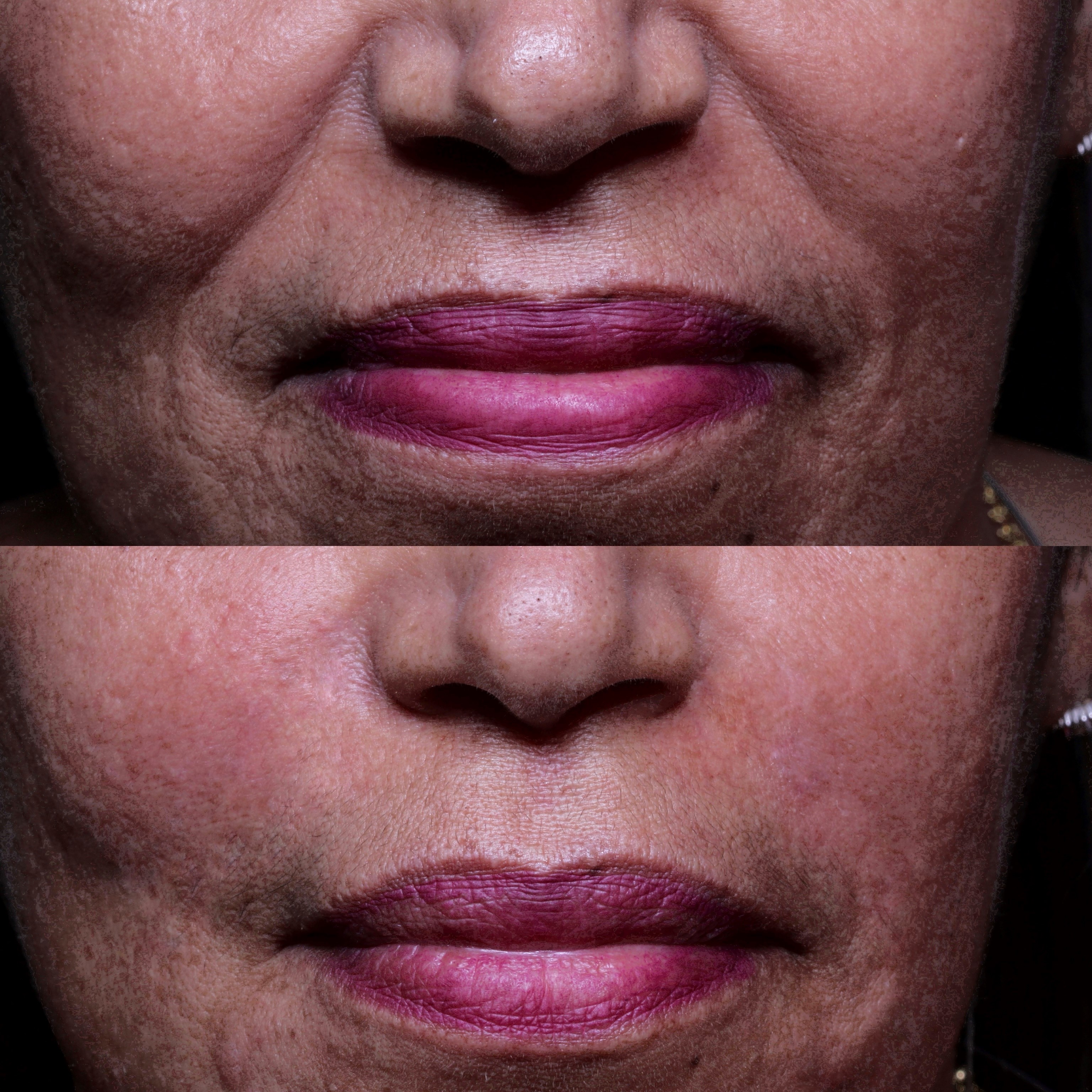 Antes e depois – suavização de linhas e contorno labial